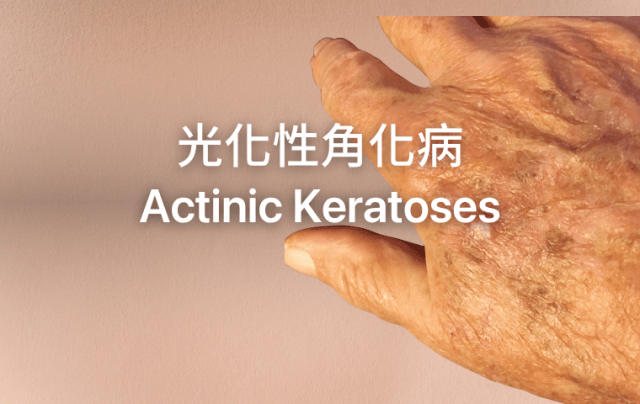 Actinic Keratoses-光化性角化病
